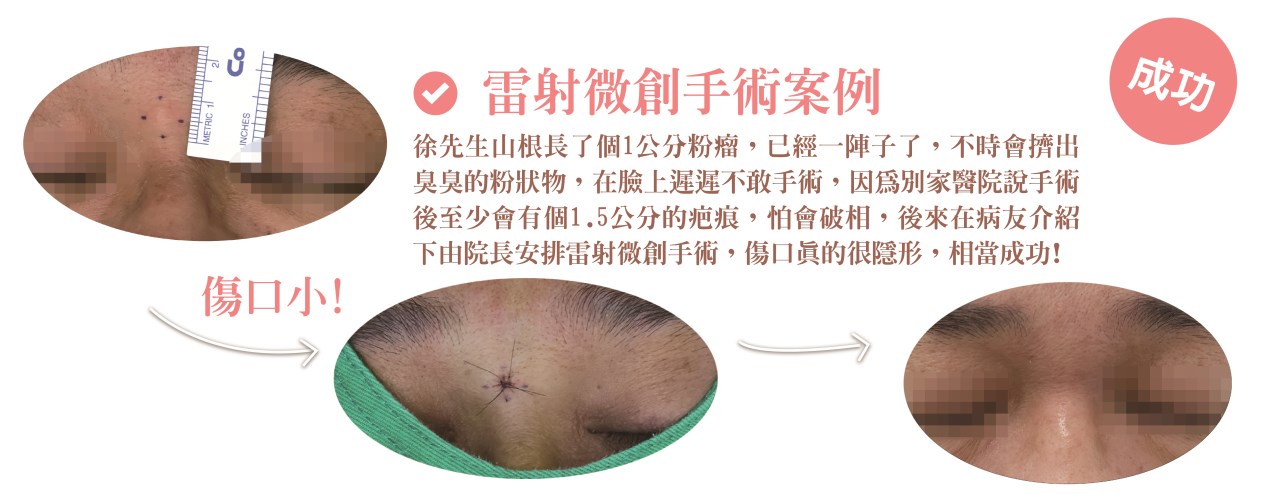 粉瘤 台中粉瘤 粉瘤手術 微創粉瘤 皮膚科 微創手術 文心極緻皮膚科診所 疤痕 