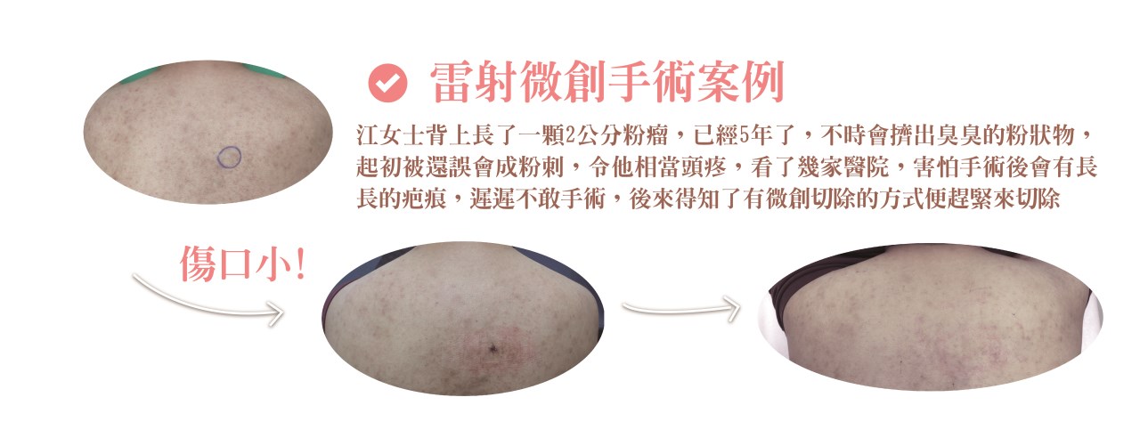 粉瘤 台中粉瘤 粉瘤手術 微創粉瘤 皮膚科 微創手術 文心極緻皮膚科診所 疤痕 