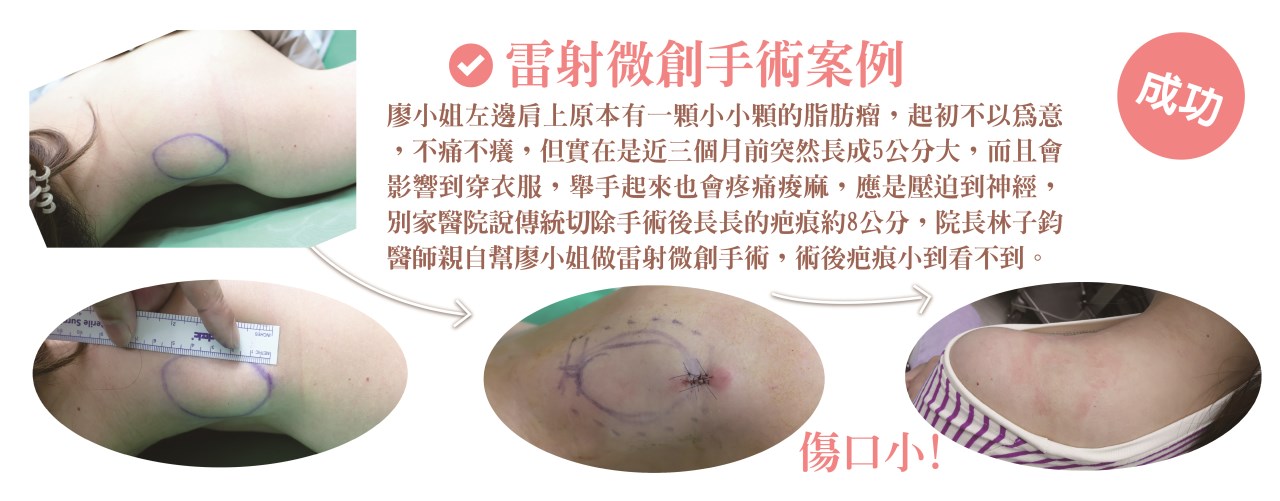 粉瘤 台中粉瘤 脂肪瘤 脂肪瘤手術 粉瘤手術 微創粉瘤 皮膚科 微創手術 文心極緻皮膚科診所 疤痕 林子鈞