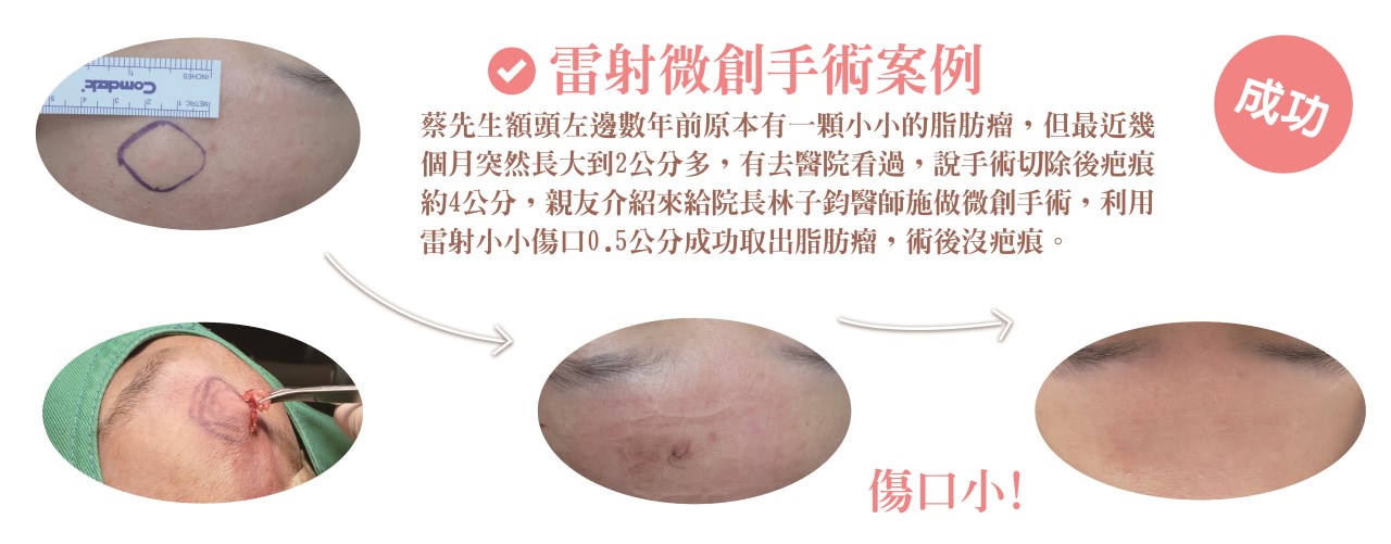 粉瘤 台中粉瘤 脂肪瘤 脂肪瘤手術 粉瘤手術 微創粉瘤 皮膚科 微創手術 文心極緻皮膚科診所 疤痕 林子鈞