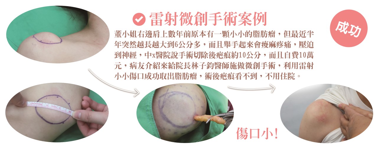 粉瘤 台中粉瘤 脂肪瘤 脂肪瘤手術 粉瘤手術 微創粉瘤 皮膚科 微創手術 文心極緻皮膚科診所 疤痕 林子鈞