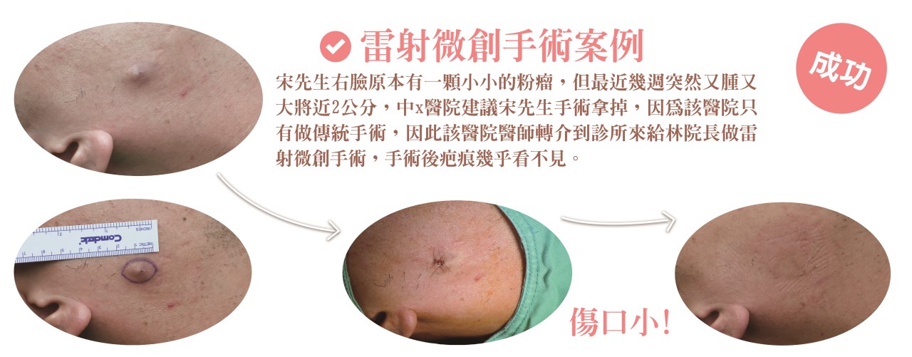粉瘤 台中粉瘤 脂肪瘤 脂肪瘤手術 粉瘤手術 微創粉瘤 皮膚科 微創手術 文心極緻皮膚科診所 疤痕 林子鈞