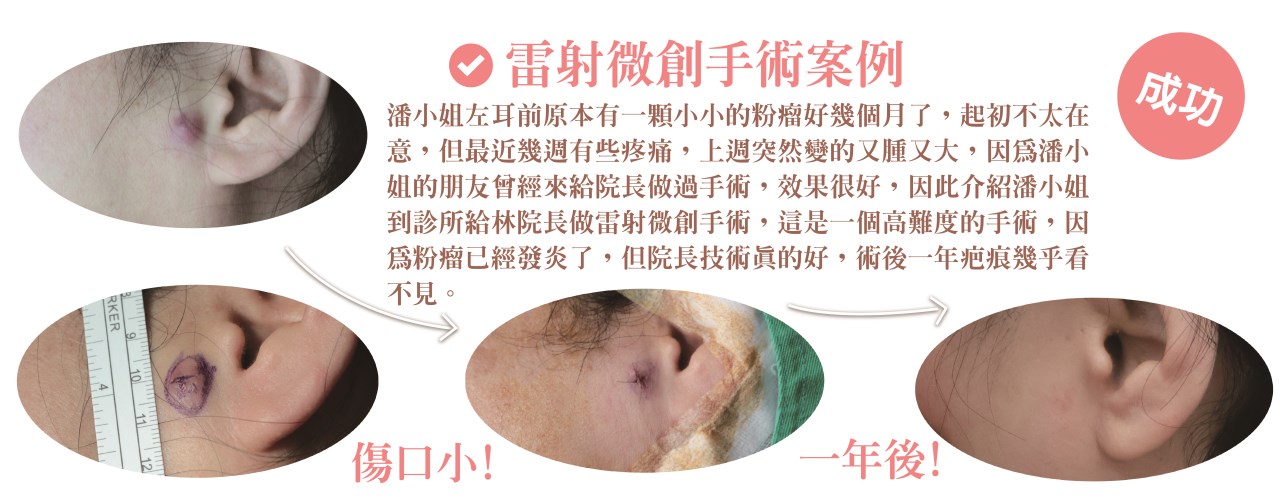 粉瘤 台中粉瘤 脂肪瘤 脂肪瘤手術 粉瘤手術 微創粉瘤 皮膚科 微創手術 文心極緻皮膚科診所 疤痕 林子鈞
