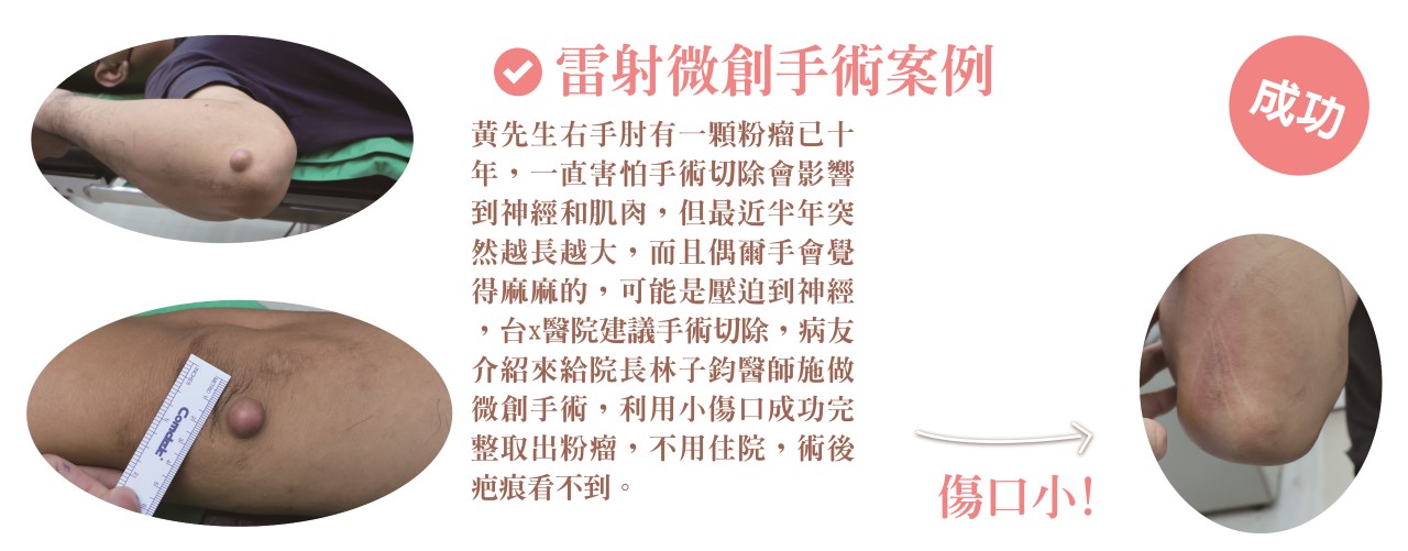 粉瘤 台中粉瘤 脂肪瘤 脂肪瘤手術 粉瘤手術 微創粉瘤 皮膚科 微創手術 文心極緻皮膚科診所 疤痕 林子鈞